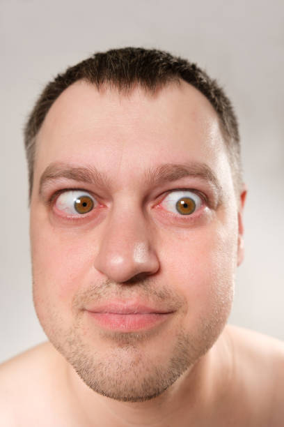 A man with strabismus squints his eyes on a white background