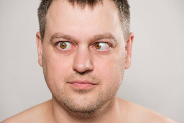 istock A man with strabismus squints his eyes on a white background. 1411846224