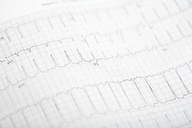 EKG or Electrocardiogram of a patient showing symptoms of Atrial Fibrillation.