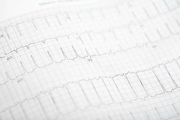 EKG showing signs of AFIB stock photo