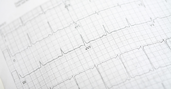 Rhythm beat pulse rate paper that shows sinus rhythm abnormality of right ventricular hypertrophy. Cardiac fibrillation. Normal sinus rhythm ECG. Vital sign. Medical healthcare symbol.