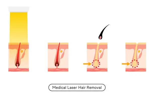 Vector illustration of Image of hair removal, the process of hair removal after medical laser hair removal treatment
