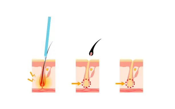 Vector illustration of Image of hair removal, the process of hair removal after needle hair removal treatment