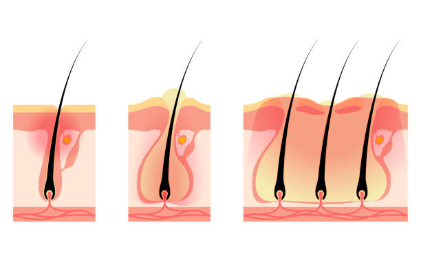 istock Image of skin problems, rough skin/acne, early to advanced folliculitis 1411956557