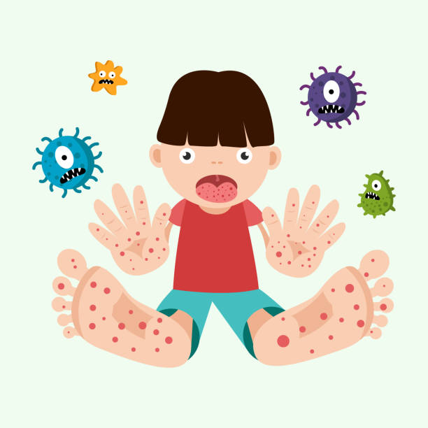 konzept der maul- und klauenseuche. kind infiziertes enterovirus. vektorillustration - zoster stock-grafiken, -clipart, -cartoons und -symbole