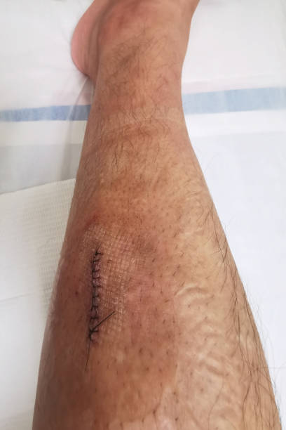 istock Skin stitches closeup after leg cyst operating surgery 1412012282