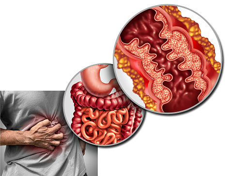 Crohn's disease pain and Crohn syndrome illness or crohns disorder as a medical concept with a close up of a human intestine with inflammation symptoms causing obstruction with 3D illustration elements.