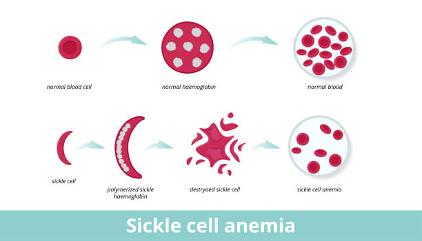 sichelzell-anämie - sickle cell anemia red blood cell blood cell anemia stock-grafiken, -clipart, -cartoons und -symbole