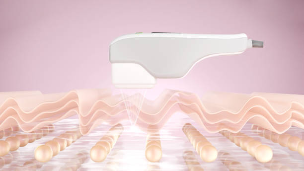 Hifu machine and laser treatment Hifu machine and laser treatment