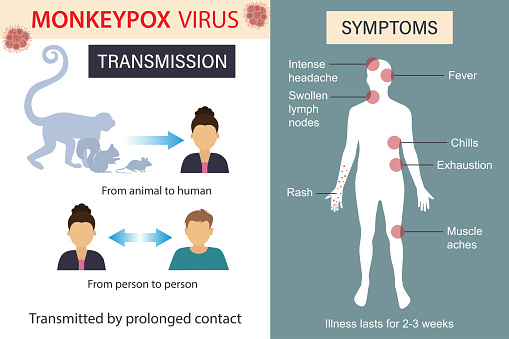 Infographics about monkey pox. Infection, symptoms, spread of monkeypox disease. Flat vector illustration.