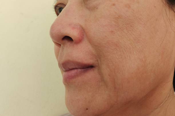 The wrinkles and flabby skin, blemishes and dark spots on the face of the woman. Portrait showing the flabbiness adipose sagging skin beside the mouth, acne and blemishes, problem wrinkled and dark spots on the face of the woman, concept health care. animal jaw bone stock pictures, royalty-free photos & images