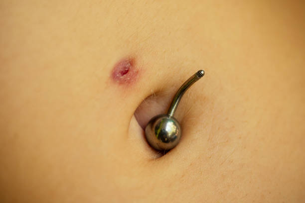 istock Belly piercing in the navel close up removal 1412241354