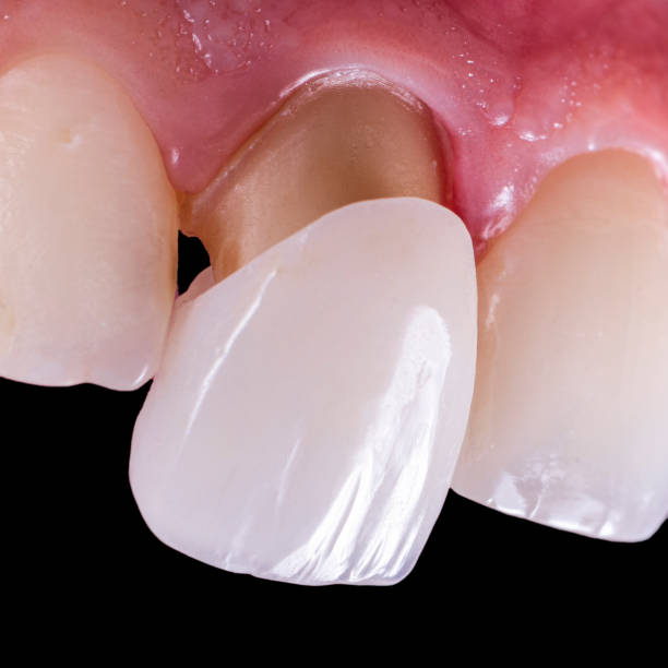 single ceramic crown bl1 color - dental implant dental hygiene dentures prosthetic equipment imagens e fotografias de stock