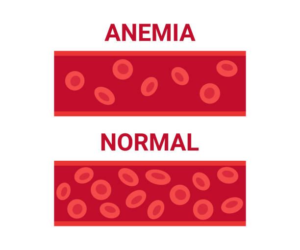 normalna i niedokrwistość krwi w porównaniu naczyń, liczba komórek erytrocytów krążenia. niski poziom hemoglobiny, niedokrwistość z niedoboru żelaza. choroba anemiczne komórki krwi. problem zdrowotny. ilustracja wektorowa - blood cell anemia cell structure red blood cell stock illustrations