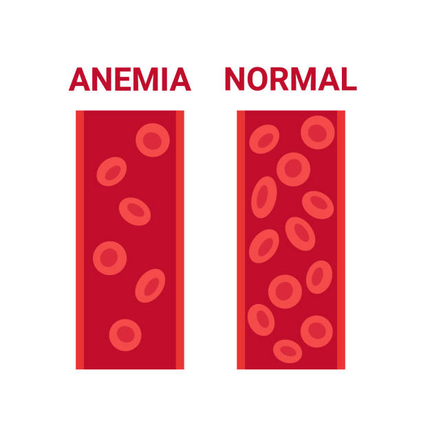 normalna i niedokrwistość krwi w porównaniu naczyń, liczba komórek erytrocytów krążenia. niski poziom hemoglobiny, niedokrwistość z niedoboru żelaza. choroba anemiczne komórki krwi. problem zdrowotny. ilustracja wektorowa - blood cell anemia cell structure red blood cell stock illustrations