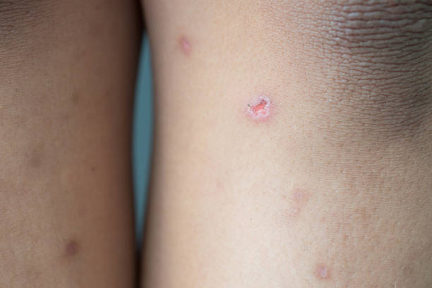 istock Scabs, dark spots on the skin on the legs 1412350302