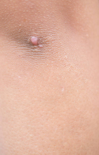 istock Blister on elbow skin. 1412363723