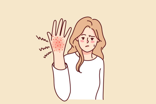 Unhappy woman suffer from rash on hand Unhappy woman suffer from redness on hand. Unwell girl struggle with psoriasis or seasonal allergy. Healthcare concept. Vector illustration. chicken pox virus stock illustrations
