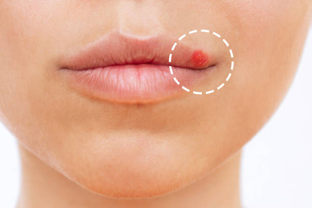 Close up of herpes on the lip. Blisters on the mouth of a young woman Herpes on the lip. Blisters on the mouth of a young woman isolated on a white background. Itching and redness on the girl's face. Close up shingles rash stock pictures, royalty-free photos & images