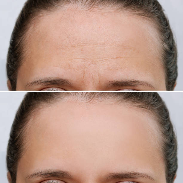 Young woman with wrinkles on a forehead before and after face lift, botox procedure Young caucasian woman with wrinkles on a forehead before and after face lift, lifting procedure isolated on a white background. Wrinkling the forehead. Anti-aging treatment. Skin care. Beauty concept wrinkled forehead stock pictures, royalty-free photos & images