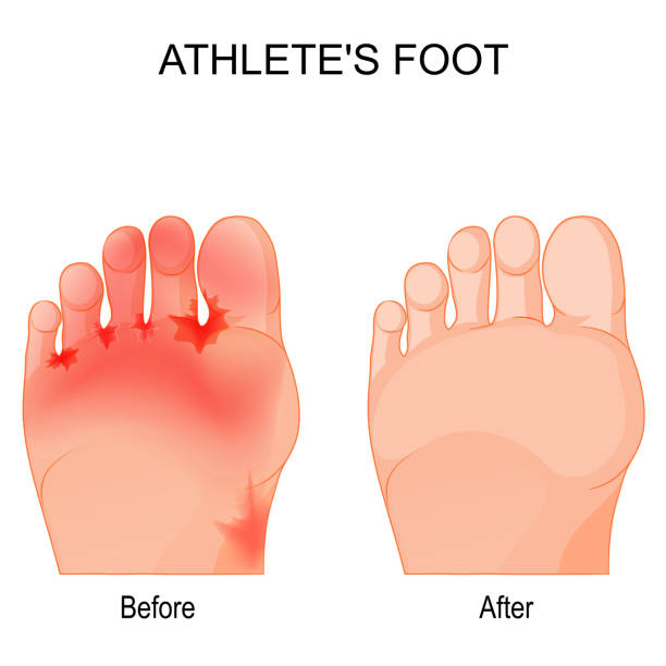 Athlete's foot before and after therapy. Athlete's foot is a fungal infection that affects the feet. Comparison and difference. Humans feet before and after therapy. vector poster tinea stock illustrations