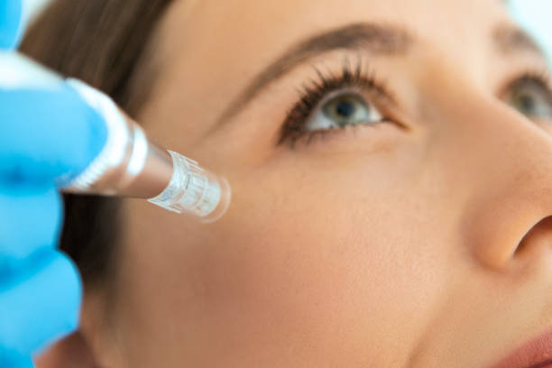 istock Dermapen skin needling treatment on a patient  skin 1412531776