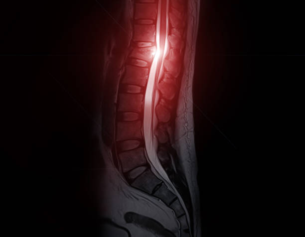istock MRI Lumbar spine sagittal T2W Fat suppression. 1412587770
