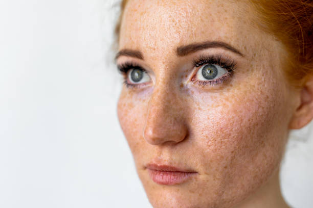 istock Freckles young woman 1412610472