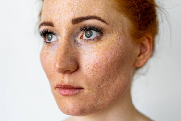 istock Freckles young woman 1412610591