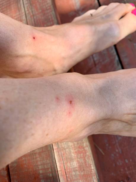 istock mosquito bites on female legs 1412611866