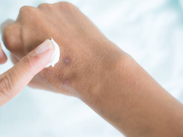 istock Scar on hand woman 1412612030