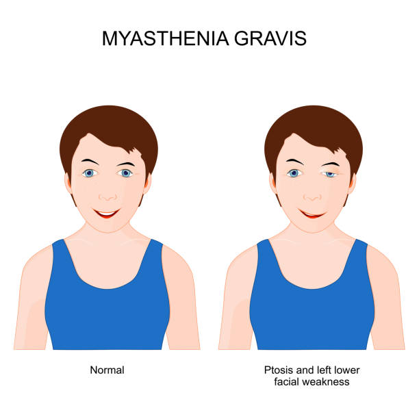 중증 근무력증. 신경 근육 질환을 앓고있는 소녀. - acetylcholine stock illustrations