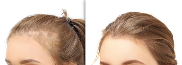 Thyroid Hair Loss Stock Photos, Pictures & Royalty-Free Images - iStock Thyroid Hair Loss Stock Photos, Pictures & Royalty-Free Images - iStock
