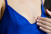 Abscess on the chest of a woman.