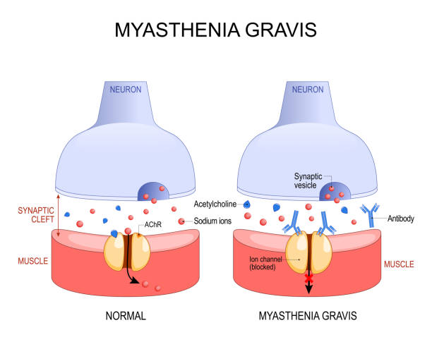 중증 근무력증. 자가 면역 질환. 뉴런과 근육. - acetylcholine stock illustrations