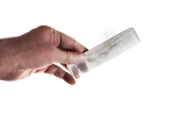 Hair loss concept of hand holding comb with fallen hairs stock photo