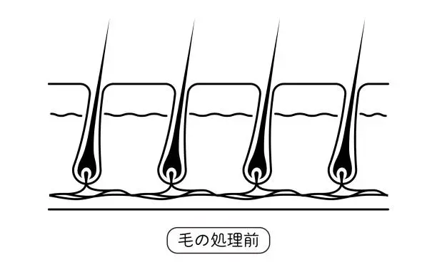 Vector illustration of Image of hair removal, before and untreated hair - Translation: before hair treatment