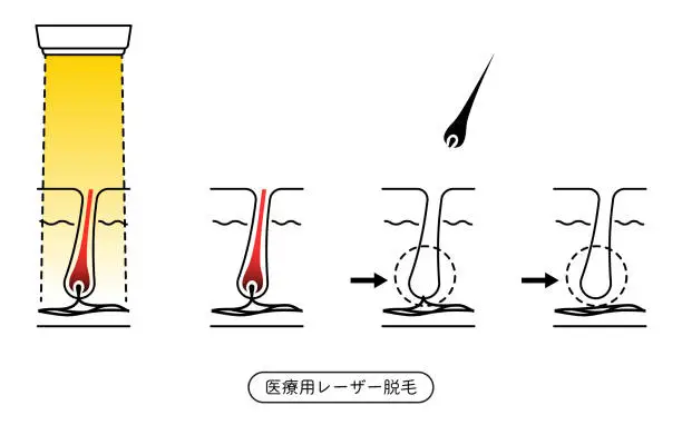 Vector illustration of Image of hair removal, the process of hair removal after medical laser hair removal treatment - Translation: Medical Laser epilation