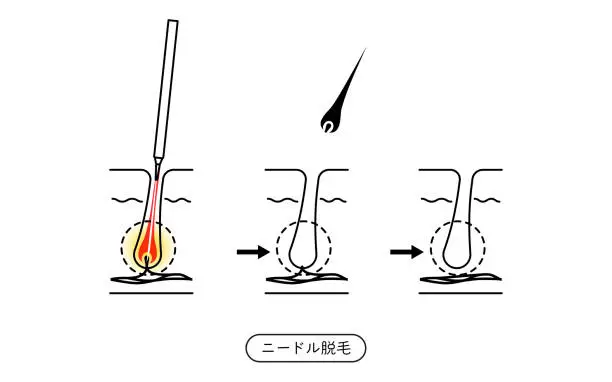 Vector illustration of Image of hair removal, the process of hair removal after needle hair removal treatment - Translation: Needle Hair Removal