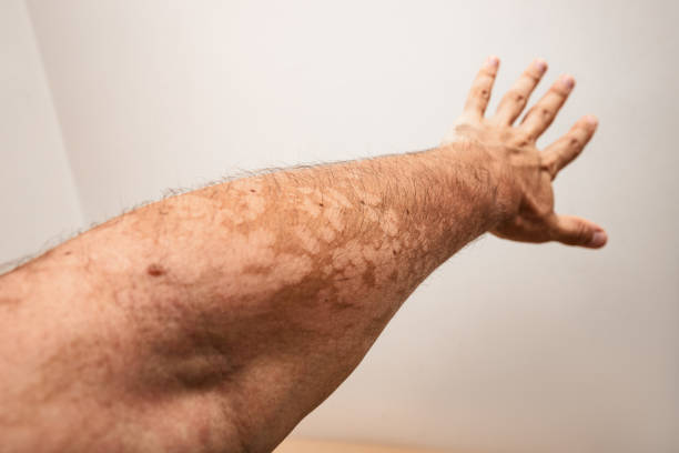 A man hand with a fungal dermatological skin disease. Symptoms of severe scratching and exfoliation of the epidermis A man hand with a fungal dermatological skin disease. Symptoms of severe scratching and exfoliation of the epidermis shingles rash stock pictures, royalty-free photos & images