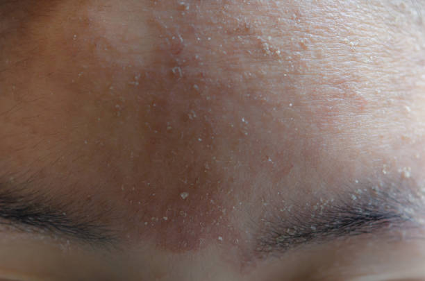istock woman with symptom of atopic dermatitis on Forehead. 1412983331