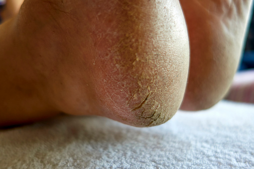 cracked and calloused soles of the feet