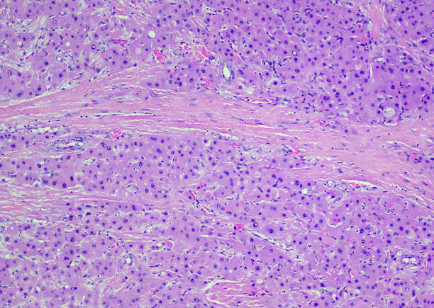 Fibrolamellar hepatocellular carcinoma stock photo