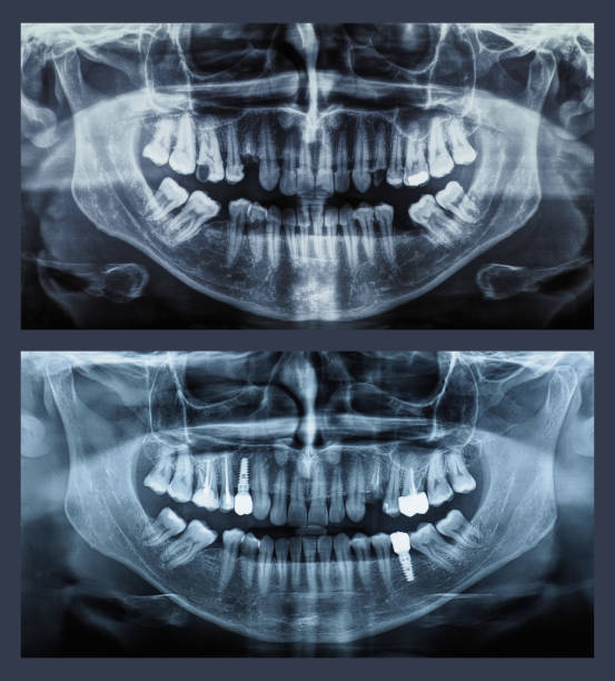 istock orthopantomograph panoramic image radiograph of teeth 1413197152