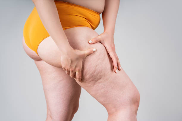 женщина с избыточным весом, толстые бедра и ягодицы, ожирение женских ног с целлюлитом - buttocks human leg women body стоковые фото и изображения