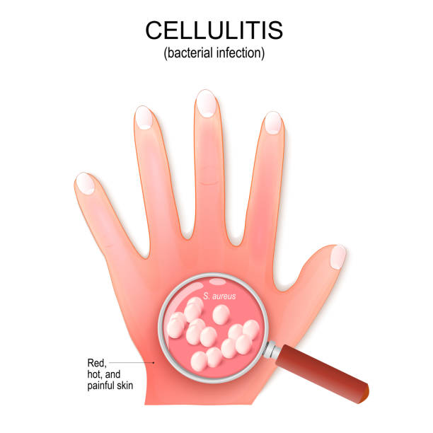 50+ Cellulitis Stock Illustrations, Royalty-Free Vector Graphics & Clip Art - iStock | Cellulitis infection, Periorbital cellulitis, Orbital cellulitis