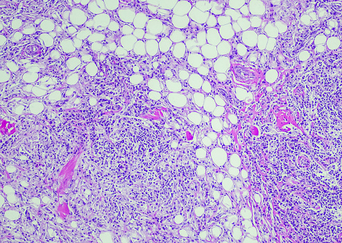 Rosai–Dorfman disease (RDD) is a rare proliferative histiocytic disorder of unknown etiology. RDD typically presents with generalized lymphadenopathy and polymorphic histiocytic infiltration of the lymph node sinuses; however, occurrences of extranodal soft tissue RDD may rarely occur when masquerading as a soft tissue sarcoma.