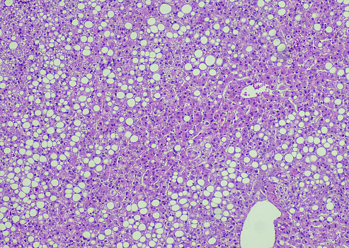 Hepatocellular adenoma (HCA; also termed hepatic adenoma) is an uncommon solid, benign liver lesion that develops in an otherwise normal-appearing liver. Typically, HCAs are solitary and are found in young women in association with use of estrogen-containing medications.