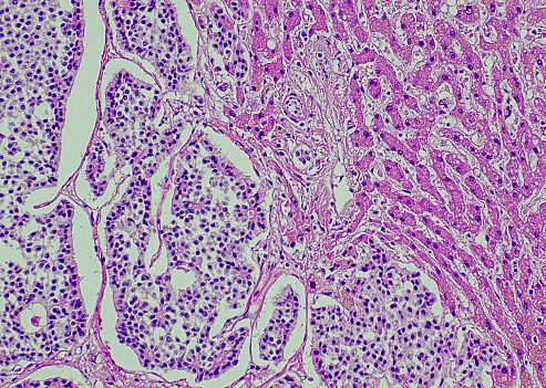 Metastatic neuroendocrine tumor. Site: Liver.  Neuroendocrine tumors are cancers that begin in specialized cells called neuroendocrine cells. Neuroendocrine cells have traits similar to those of nerve cells and hormone-producing cells. Neuroendocrine tumors are rare and can occur anywhere in the body.