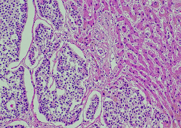 Metastatic neuroendocrine tumor, Liver stock photo